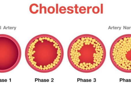 Cholesterol building up in artery